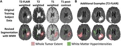 Multi-Disease Segmentation of Gliomas and White Matter Hyperintensities in the BraTS Data Using a 3D Convolutional Neural Network